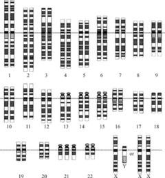 Le caryotype de la trisomie 21