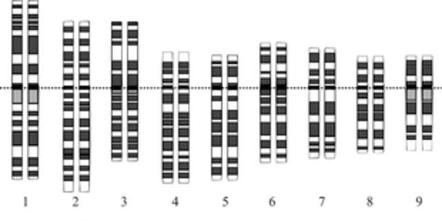 Le caryotype de la trisomie 21